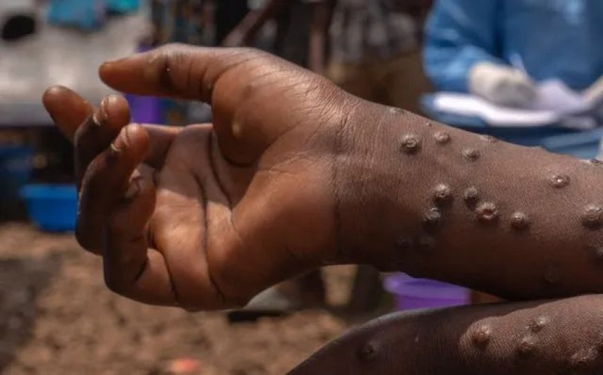 Ghana Records Fourth Mpox Case as Tarkwa Nsuaem Municipality Confirms Infection; Health Authorities Heighten Vigilance
